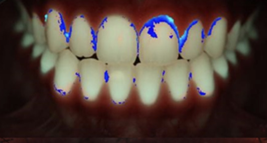 trainingen Oral Qamera tandplak zichtbaar